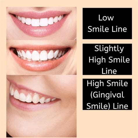 What Is A Gingival Smile Line Empire Dental