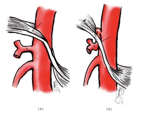 Median Arcuate Ligament Syndrome Mals The Operative Review Of Surgery