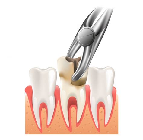 Painless Tooth Extraction Treatment Painless Tooth Extraction