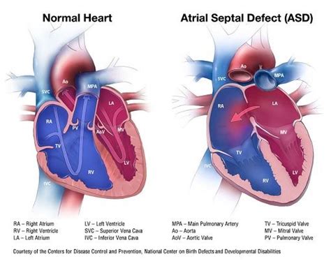 Atrial Septal Defect Atrial Septal Defect Cardiac Nursing Pediatric