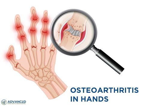 Osteoarthritis In Hands