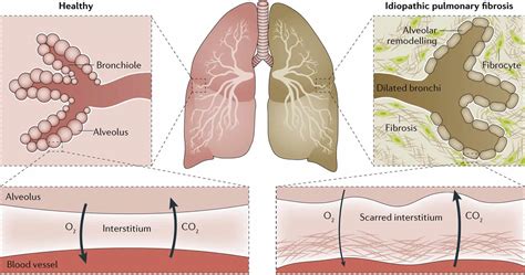 Pulmonary Fibrosis Causes Types Symptoms Diagnosis Stages And Treatment