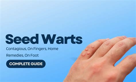 Seed Warts Contagious On Fingers Home Remedies On Foot Resurchify