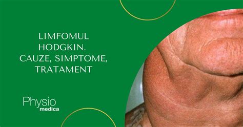 Limfomul Hodgkin Cauze Simptome Diagnostic Tratament Cancerul Hodgkin