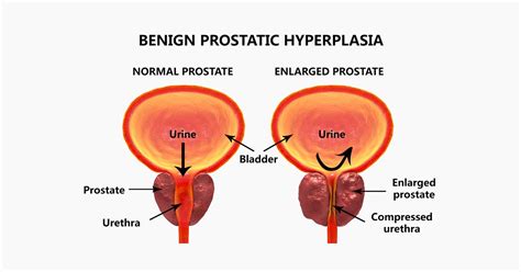 Drugs Used In Benign Prostatic Hyperplasia Bph Aerochem Neutron My Xxx Hot Girl