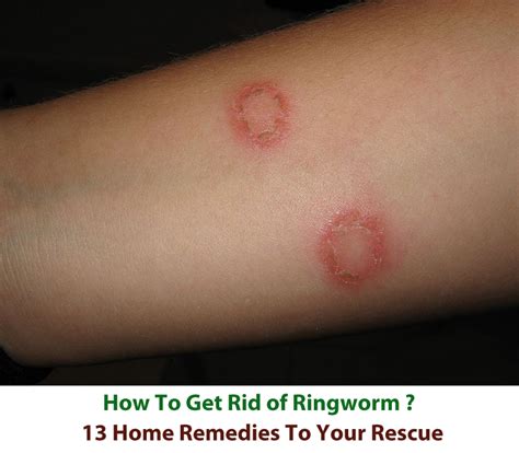How To Get Rid Of Ringworm Fast 13 Home Remedies To Your Rescue