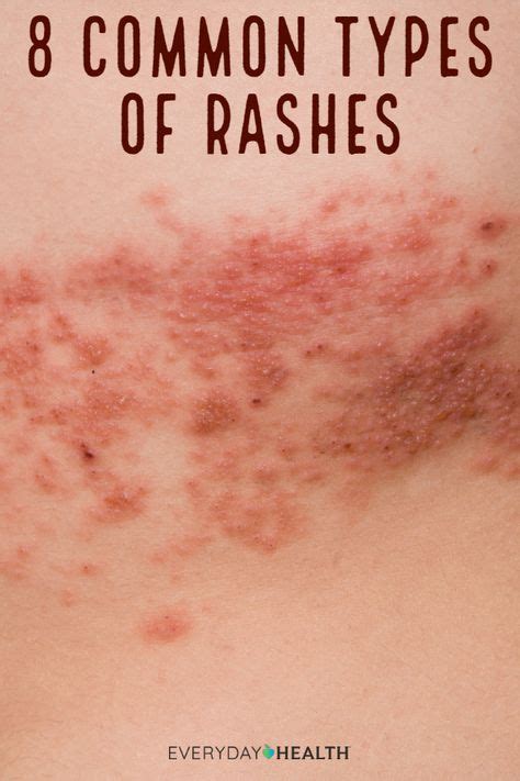 Common Types Of Rashes Skin Beauty Hair Types Of Rashes