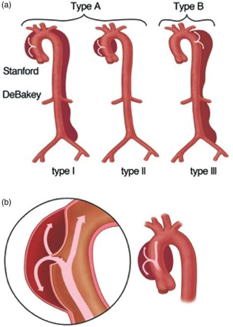 A Types Of Aortic Dissection According To The Stanford Classification