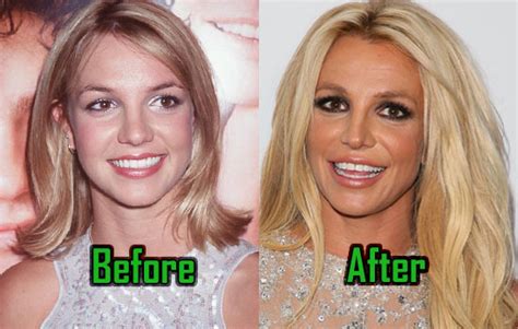 Britney Spears Plastic Surgery Behind Her Unusual Look Before After Celebritysurgeryicon