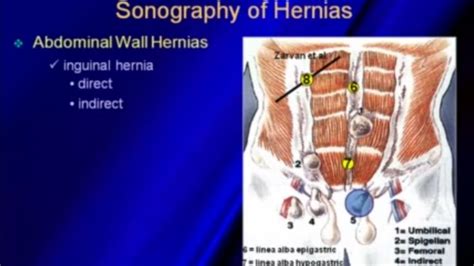 Ultrasound Of Hernias Umbilical Hernia Sonography Ultrasound