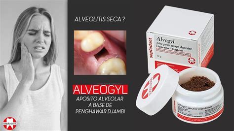 Alveogyl Recubrimiento De Alveolitis Seca Septodont Youtube
