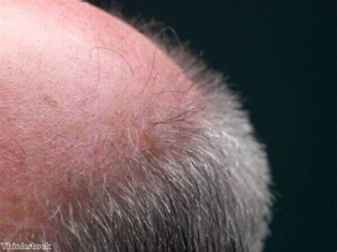 Researchers On The Verge Of Cure For Baldness Labmate Online