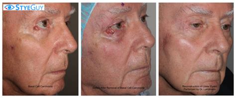 Basal Cell Carcinoma Removal And Reconstruction Styeguy