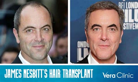 James Nesbitts Hair Transplant A Complete Guide To The Journey Of