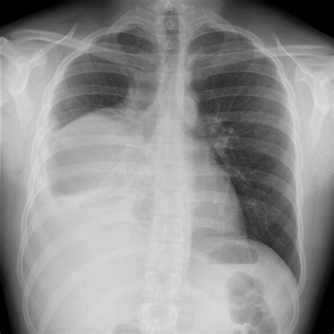 Chest X Ray Showing A Mediastinal Mass Protruding To The Right