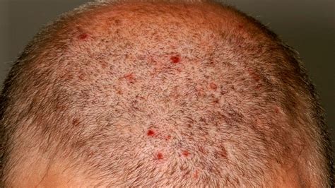 Painful Pimples On Scalp Causes Treatment And Prevent