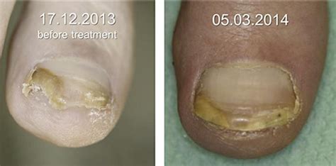 Top 73 Pseudomonas Nail Infection Treatment Nhs Architectures Eric