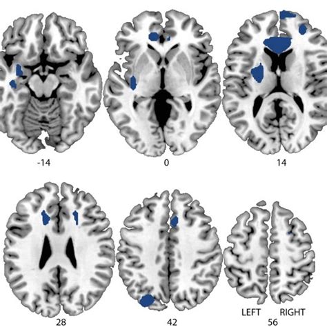 Grey Matter Densities In Healthy Controls And Patients With