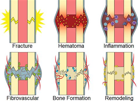 Bleeding from fracture site and surrounding soft tissues creates a hematoma, which provides a source of hematopoietic cells capable of secreting growth factors. Cellular biology of fracture healing - Bahney - 2019 ...