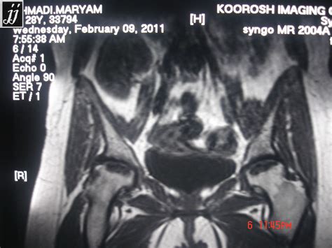 Radioogle MSK Bi Lateral Avascular Necrosis Or AVN Of Femoral Heads