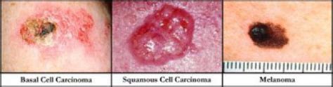 Skin Cancer Dermatology Pictures Photos