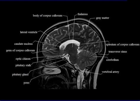 Cross Sectional Anatomy Of The Brain Brain Mri Interv