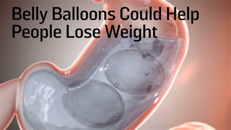 This Belly Balloon Could Help People Lose Weight Youtube