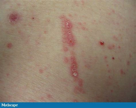 A 48 Year Old Woman With An Itchy Rash