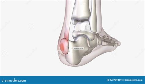 Haglunds Deformity Is Bony Enlargement At The Back Of The Heel Leading To Painful Bursitis