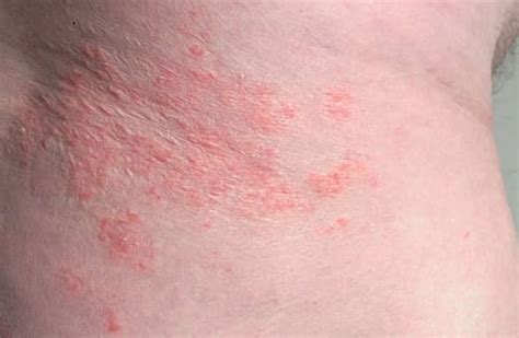 Are Psoriasis And Acne Related Types Of Acne And Psoriasis