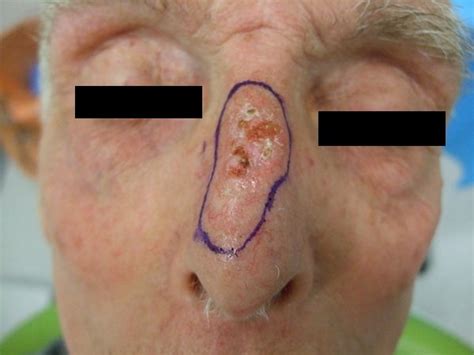 Basal Cell Cancer Of The Nose Dr Vindy Ghura Dermatologist Manchester