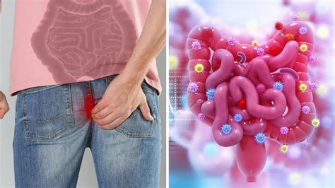 10 Early Warning Signs Of Colon Cancer You Should Not Ignore Youtube