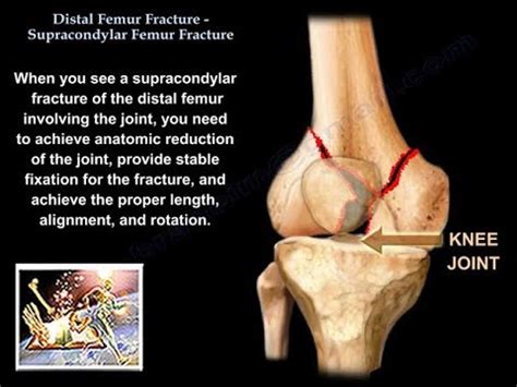 Distal Femur Supracondylar Fracture Everything You Need To Know Dr Nabil Ebraheim Youtube