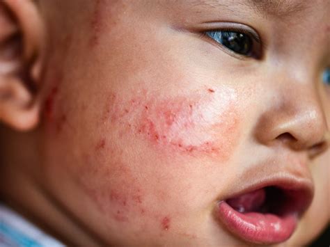 Is Your Babys Skin Extra Sensitive How To Know