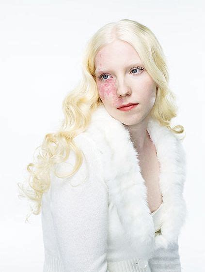 Portraits Focusing On People With Type 1 Albinismbeautiful