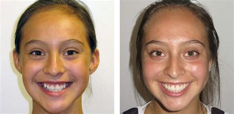 Damon Braces Before And After Pictures Best Orthodontist In Temecula