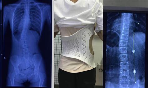 Sls 3d Printed Nylon Back Brace For Scoliosis Patients Facfox