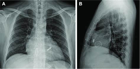 Chest Radiography After The Procedure A Posteroanterior View B