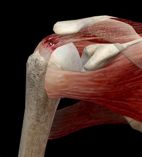 Learn Muscle Anatomy Of Dads And Rotator Cuff Injuries