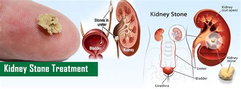 Homeopathic Medicines For Kidney Stone Homeopathy