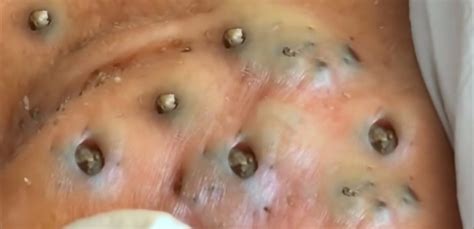 Giant Pimple Popping Removal Big Blackhead Extraction