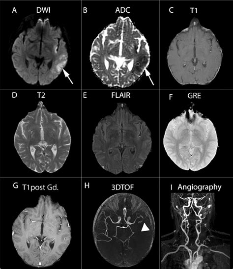 Comprehensive Mri Assessment In Acute Stroke Using Dwi Pwi And Mr
