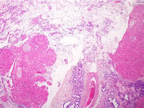 Leydig Cell Hyperplasia Mimicking A Testicular Tumour In A Patient With