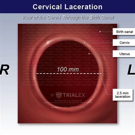 Cervical Laceration Trialexhibits Inc