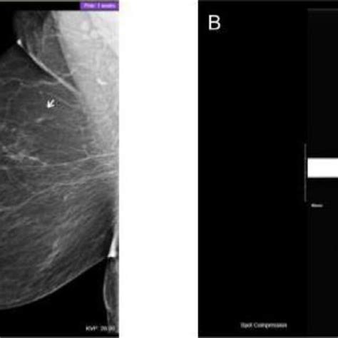 Mammogram Imaging Of Upper Right Breast A Mammogram Screening Shows