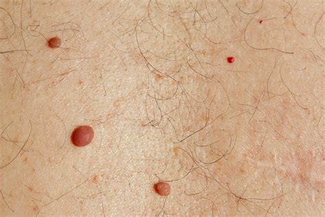 Jojo Bentley Skin Cherry Angioma Pictures How To Remove Cherry Angiomas Red Moles The