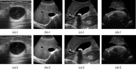 Real Us Images Obtained By Sonoace X6 And Accuvix Xg A 1 To D 1 Breast