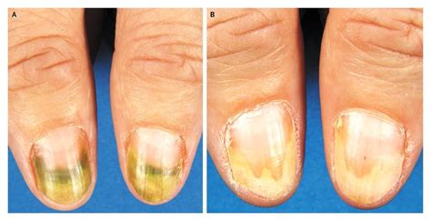 Green Nail Syndrome