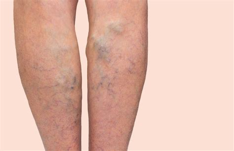 What Are The Treatment Options For Varicose Veins