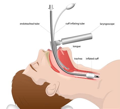 Swallowing Difficulties After Intubation Keeping Me Well